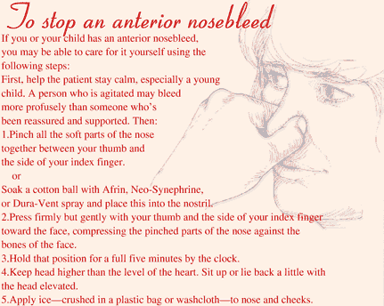 How to stop an anterior nosebleed