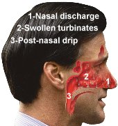 post-nasal drip